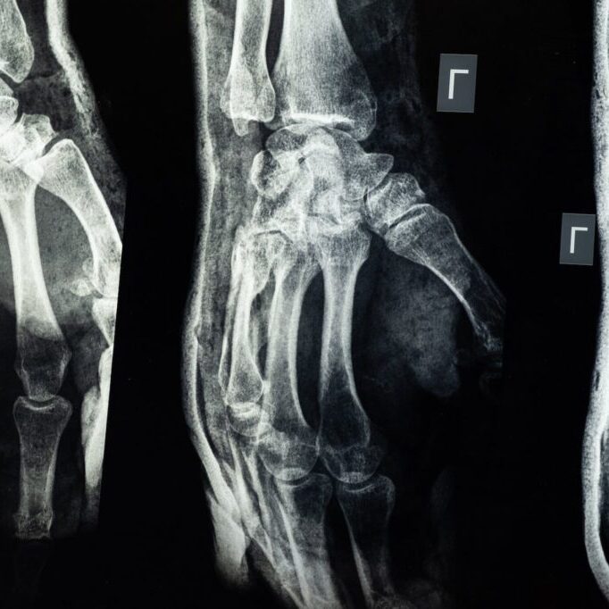 medical imaging of an injury on the hand